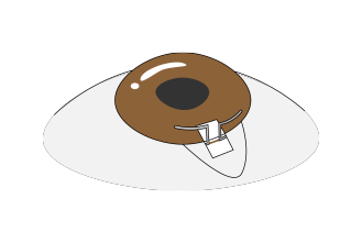 トラベクロトミー