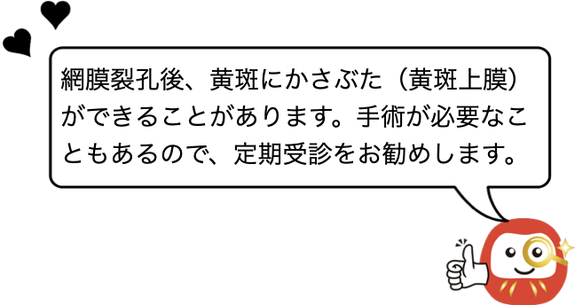 網膜裂孔後、黄斑にかさぶた（黄斑上膜）ができることがあります。手術が必要なこともあるので、定期受診をお勧めします