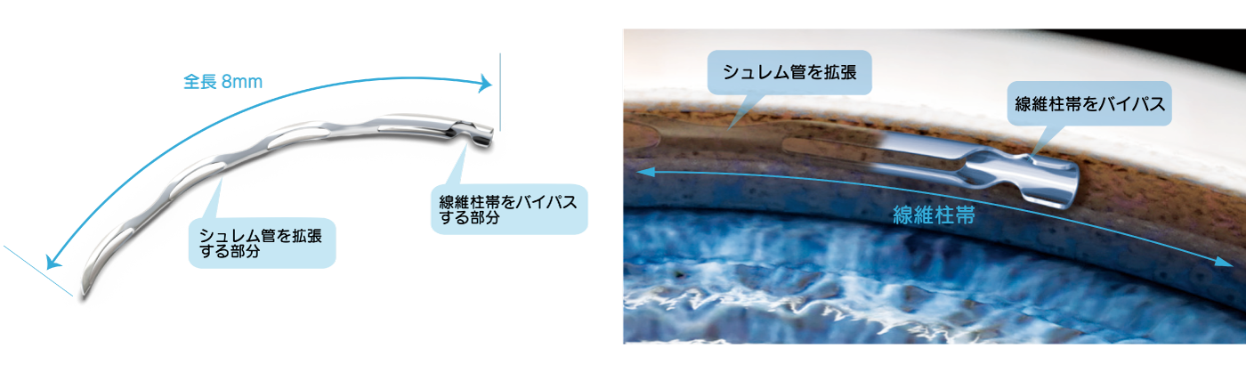 ハイドラスマイクロステント　図解