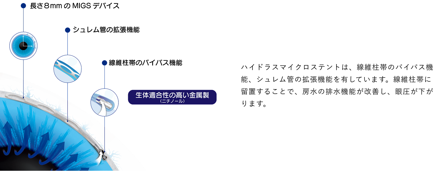 ハイドラスマイクロステント原理の模式図