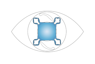 アドオン眼内レンズ