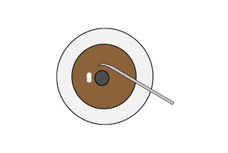 マイクロフックトラベクロトミー