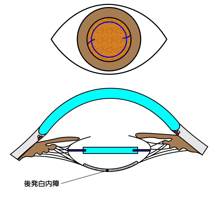 後発白内障