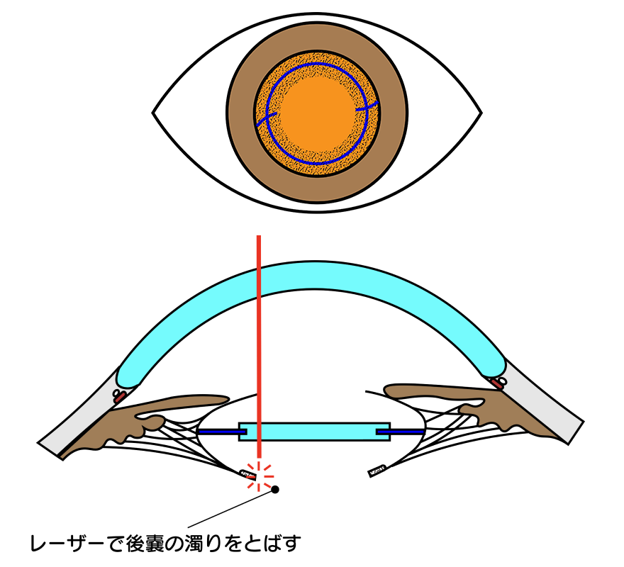 レーザー後