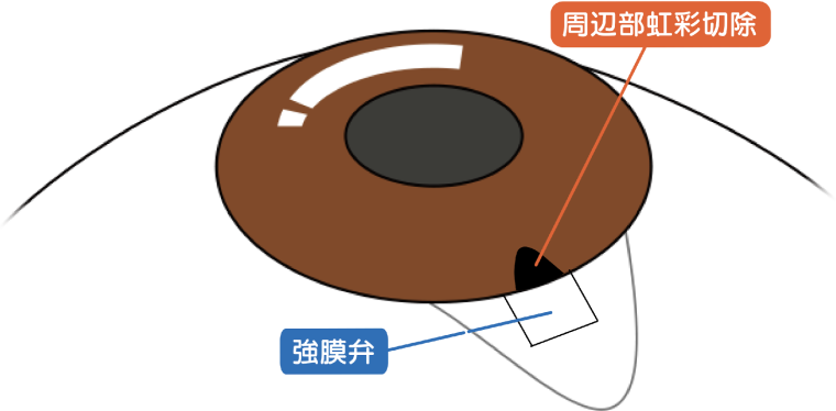 周辺部虹彩切除