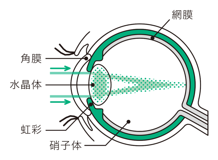 白内障の眼