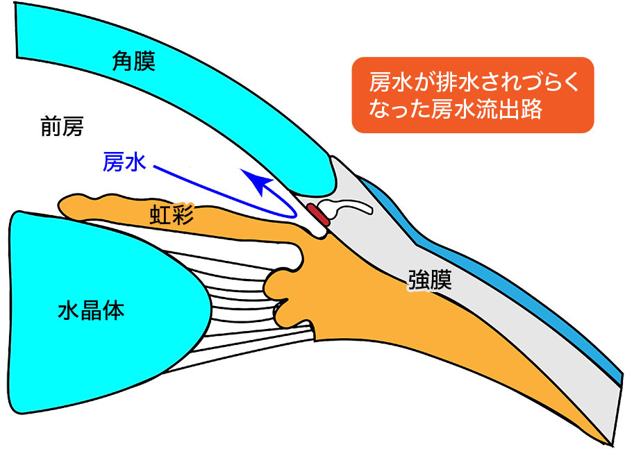 房水が排水されづらくなった房水流出路