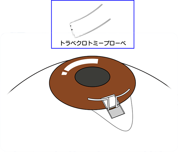 手術の手順3